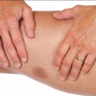 Tubuh Memar Secara Tiba-tiba Padahal Tidak Sedang Terluka? Ternyata Ini Alasannya