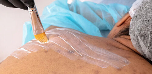 Cara Menghilangkan Jerawat di Punggung Secara Alami dan Efektif